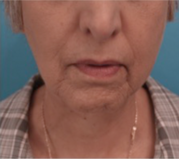 Kybella Patient