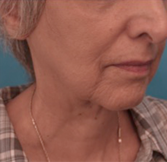 Kybella Patient #6 After Photo # 10