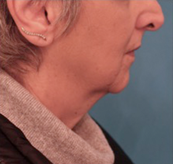 Kybella Patient #6 Before Photo # 7