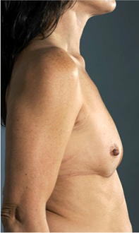 Breast Augmentation (Implants) Patient #16 Before Photo # 5