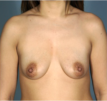 Breast Augmentation (Implants) Patient #14 Before Photo Thumbnail # 1