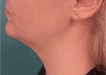 Kybella Patient #16 After Photo # 6