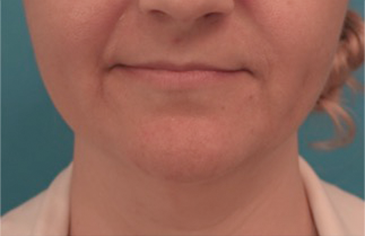 Kybella Patient #16 Before Photo # 1