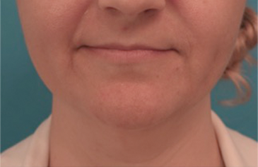 Kybella Patient