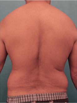 Male Liposuction Patient #6 Before Photo # 1