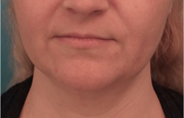 Kybella Patient #16 After Photo Thumbnail # 2