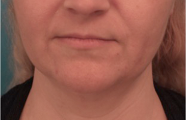 Kybella Patient