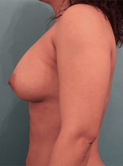 Breast Augmentation (Implants) Patient #13 After Photo # 4