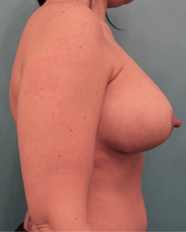 Breast Augmentation (Implants) Patient #12 After Photo # 6