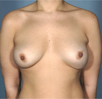 Breast Augmentation (Implants) Patient #12 Before Photo Thumbnail # 1