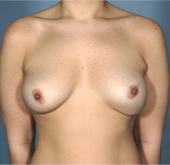 Breast Augmentation (Implants) Patient #12 Before Photo # 1