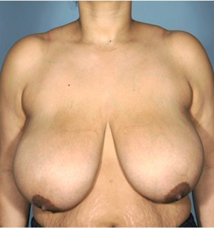 Breast Lift Patient #8 Before Photo Thumbnail # 1