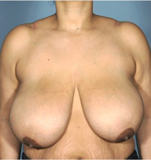 Breast Lift Patient #8 Before Photo # 1