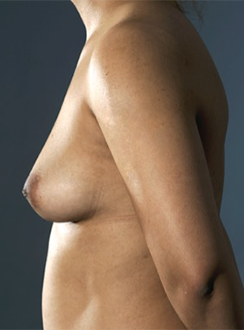Breast Augmentation (Implants) Patient #13 Before Photo # 3