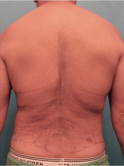 Male Liposuction Patient