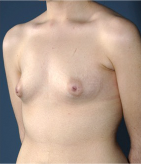 Breast Augmentation (Implants) Patient #15 Before Photo # 3