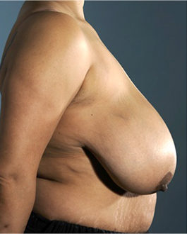 Breast Lift Patient #8 Before Photo # 5