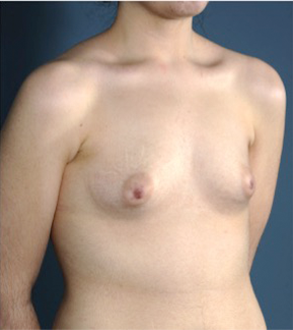 Breast Augmentation (Implants) Patient #15 Before Photo Thumbnail # 7