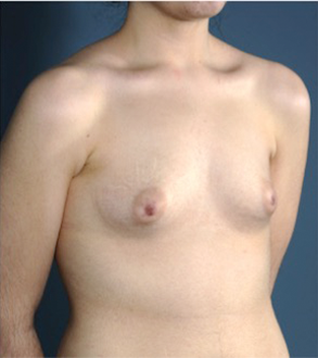 Breast Augmentation (Implants) Patient #15 Before Photo # 7