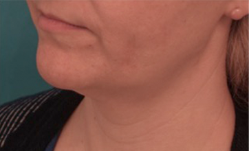 Kybella Patient #16 After Photo # 4