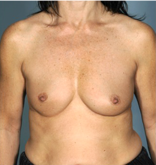 Breast Augmentation (Implants) Patient #16 Before Photo Thumbnail # 1