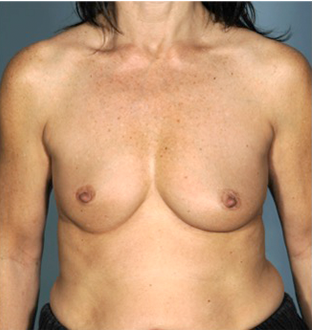 Breast Augmentation (Implants) Patient