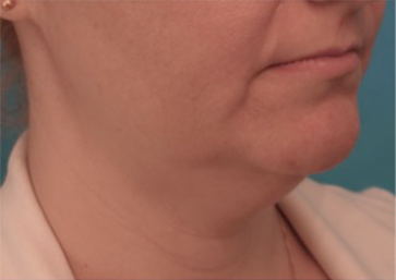 Kybella Patient #16 Before Photo # 7