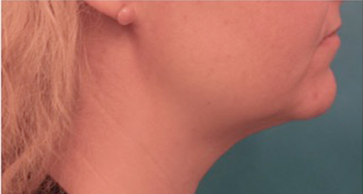 Kybella Patient #16 After Photo Thumbnail # 10