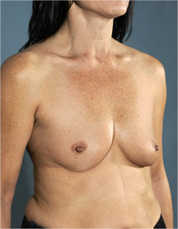 Breast Augmentation (Implants) Patient #16 Before Photo Thumbnail # 3