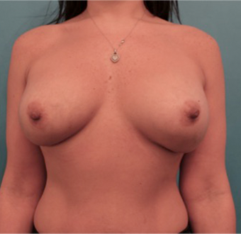 Breast Augmentation (Implants) Patient #12 After Photo # 2