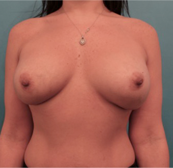 Breast Augmentation (Implants) Patient