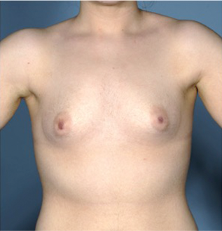 Breast Augmentation (Implants) Patient #15 Before Photo Thumbnail # 1