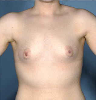 Breast Augmentation (Implants) Patient #15 Before Photo # 1