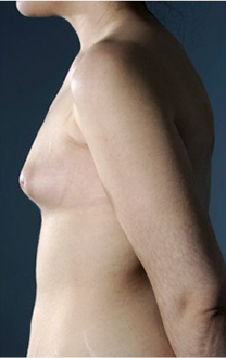 Breast Augmentation (Implants) Patient #15 Before Photo # 5