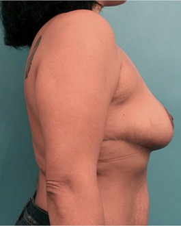 Breast Lift Patient #8 After Photo # 6