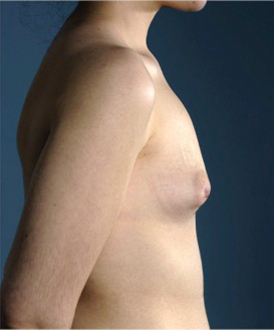 Breast Augmentation (Implants) Patient #15 Before Photo Thumbnail # 9