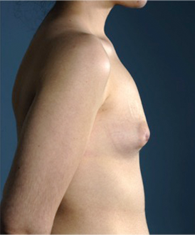 Breast Augmentation (Implants) Patient #15 Before Photo # 9