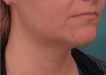 Kybella Patient #16 After Photo # 8