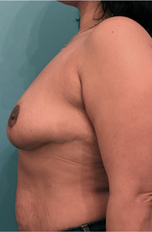 Breast Lift Patient #8 After Photo # 10