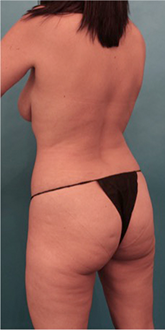 Brazilian Butt Lift Patient #4 Before Photo Thumbnail # 3