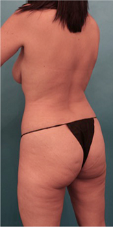 Brazilian Butt Lift Patient #4 Before Photo # 3