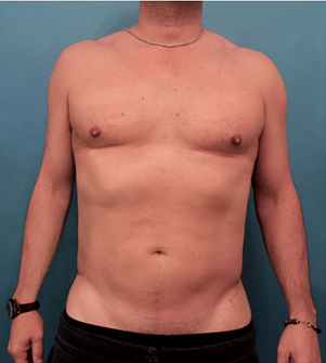 Body Contouring Kybella Patient #1 After Photo Thumbnail # 2
