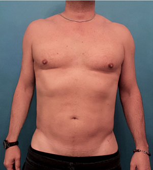 After Image: Body Contouring Kybella Patient #1 - 