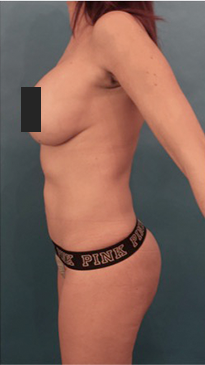 Liposuction Patient #16 After Photo # 6