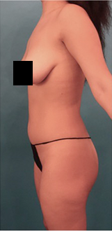 Liposuction Patient #14 Before Photo # 5