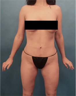 After Image: Liposuction Patient #15 - 