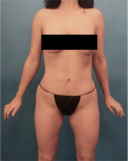 Liposuction Patient