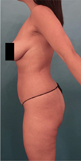 Brazilian Butt Lift Patient #4 Before Photo # 1