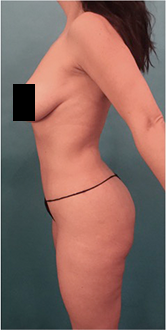 Brazilian Butt Lift Patient #4 After Photo # 2