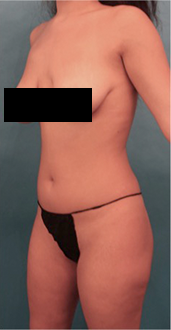 Liposuction Patient #14 Before Photo # 3